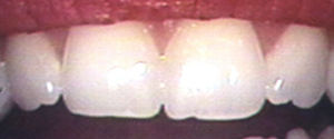 Enamel Shaping in Massapequa