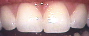 Enamel Shaping in Massapequa