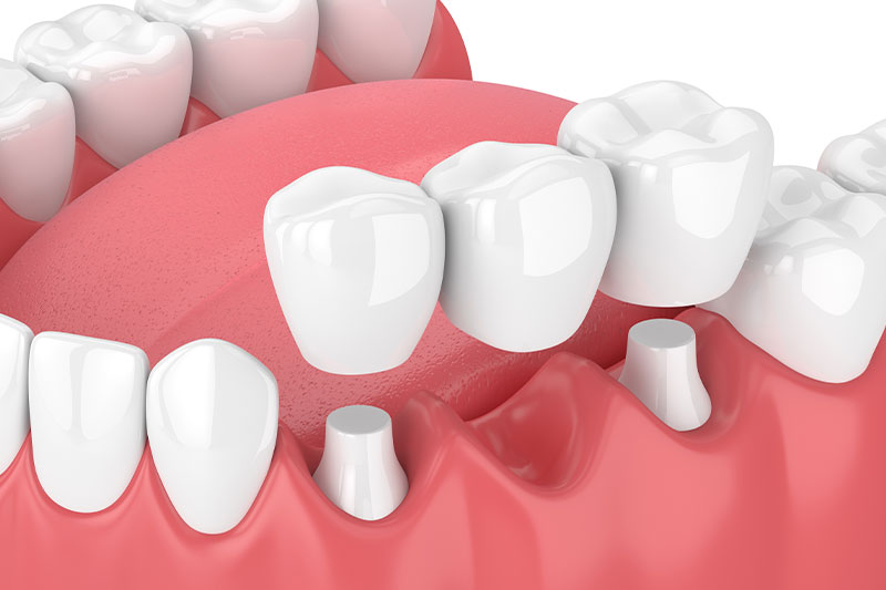 Quality Dental Treatments in Massapequa