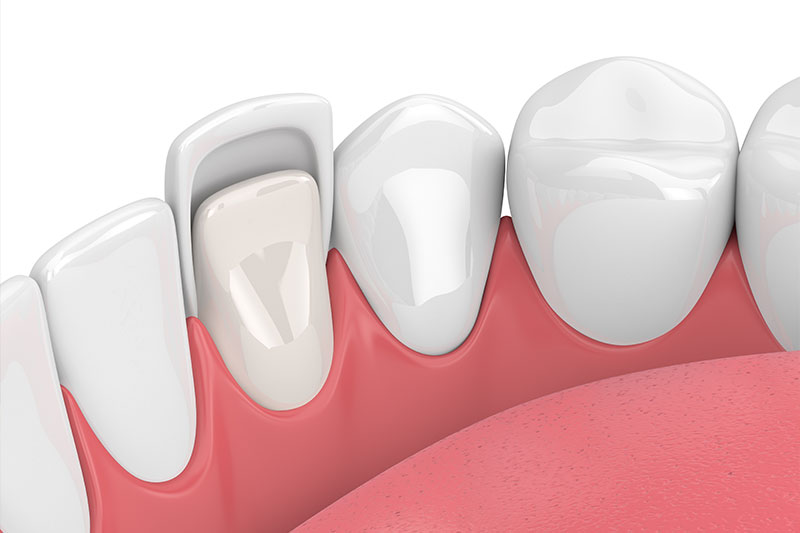 Porcelain Veneers in 