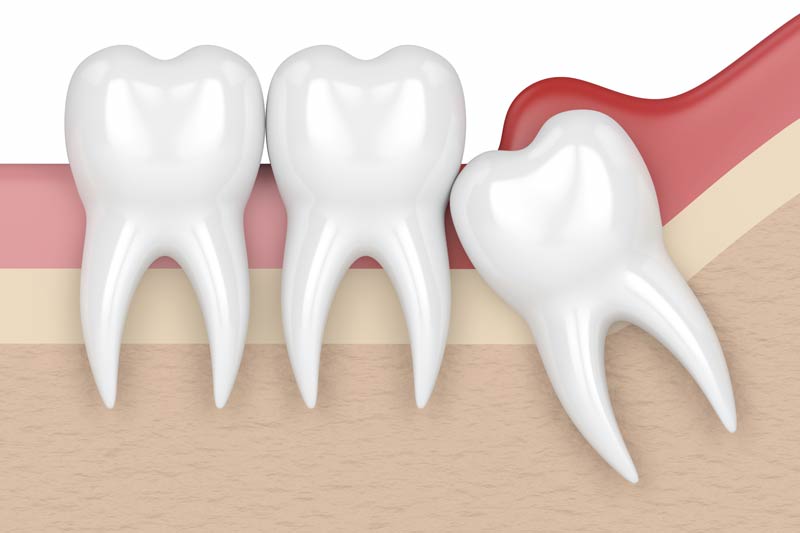 Wisdom Tooth Removal in Massapequa