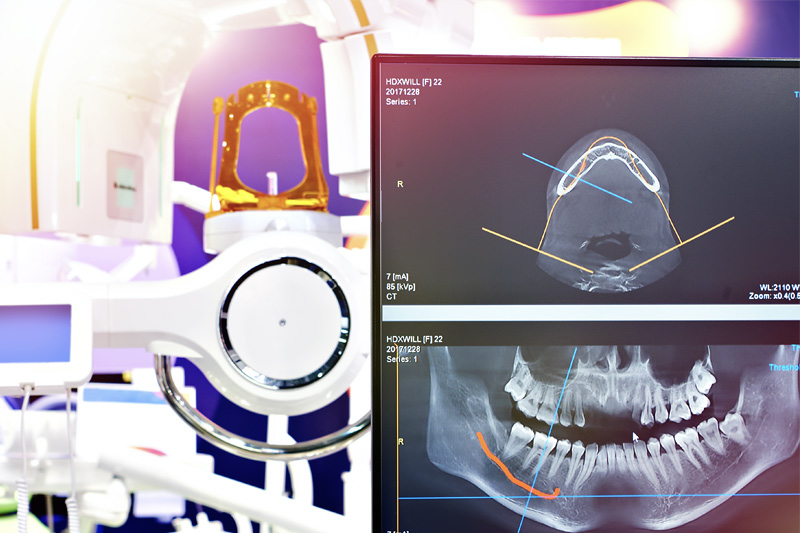 Digital X-Rays in Massapequa